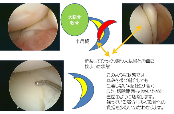 半月板縫合(フィブリンクロット縫合） 2.半月板を残せ！！