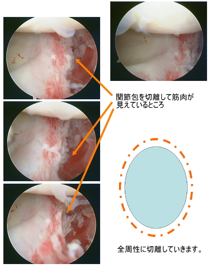 肩関節鏡下手術 - 健康/医学
