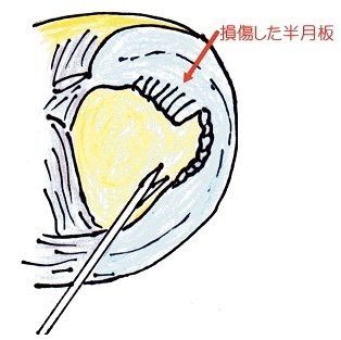 裁断 半月板のすべて 半月板のすべて−解剖から縫合手術,再生治療まで | 宗田 大