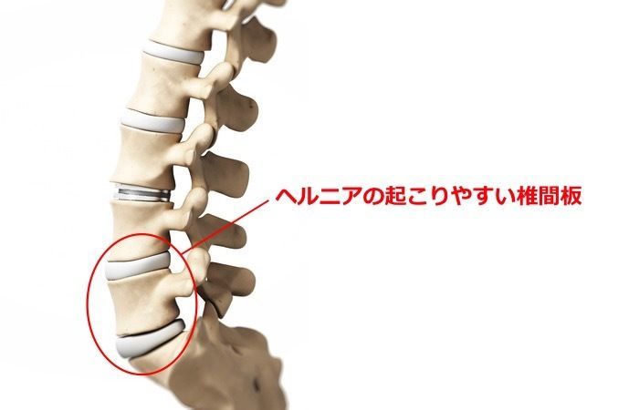 腰椎椎間板ヘルニアの症状と運動療法 ストレッチについて アレックス脊椎クリニック