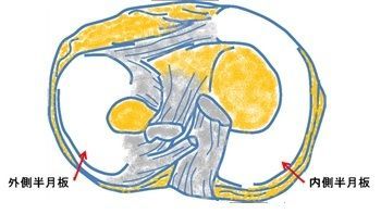 第9回 日本膝 関節鏡 スポーツ整形外科学会 半月板単独損傷の損傷側における因子の検討 発表報告 Ar Ex 尾山台整形外科