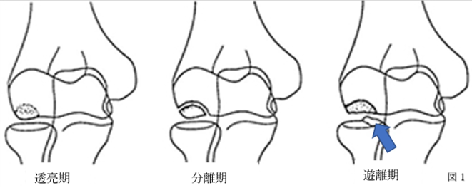 上腕骨小頭離断性骨軟骨炎 Ar Ex 尾山台整形外科