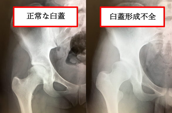 股関節唇損傷 | AR-Ex 尾山台整形外科