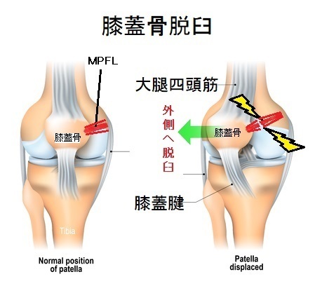 膝のお皿がずれる 外れる 膝蓋骨脱臼 内側膝蓋大腿靱帯 Mpfl損傷 長野整形外科クリニック