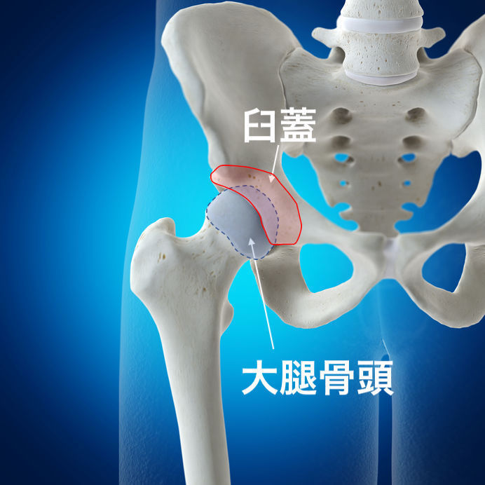 股関節臼蓋形成不全の治療法 | 佐久平整形外科クリニック
