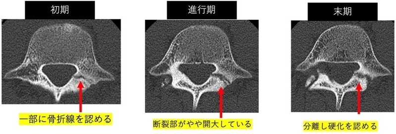 腰椎分離症 上田整形外科内科