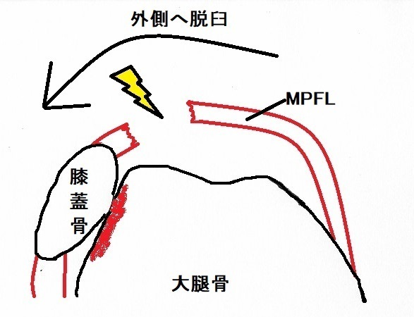 膝蓋骨脱臼 内側膝蓋大腿靱帯 Mpfl損傷 長野整形外科クリニック