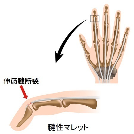 突き指をして指が伸びなくなった時の原因と治療法 マレット指 マレットフィンガー 槌指 長野整形外科クリニック