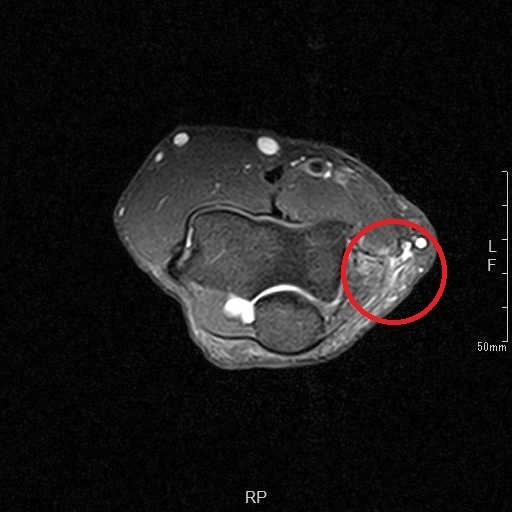 ゴルフのインパクト時の右肘内側部の痛みの治療 Ar Ex Medical Group