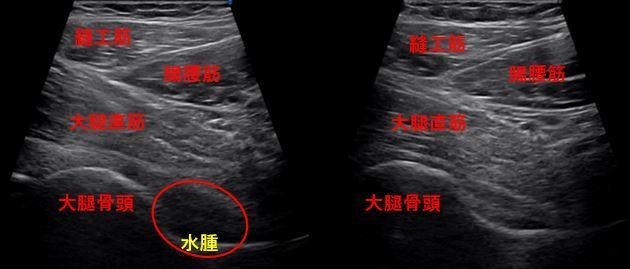 u003cスポーツ障害\u003e筋損傷のエコー活用術自然医療薬学健康 - www