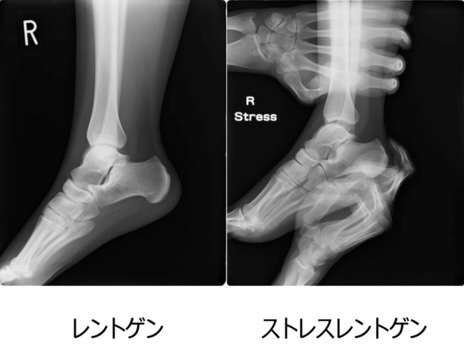 足関節捻挫 外側靱帯損傷 上田整形外科内科