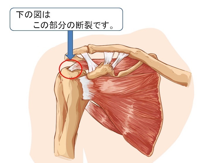 肩関節鏡下手術 - 健康/医学