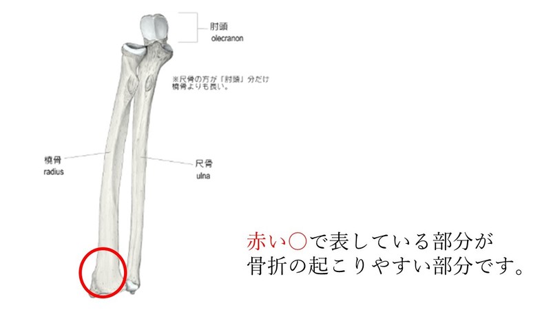 橈骨遠位端骨折 上田整形外科内科
