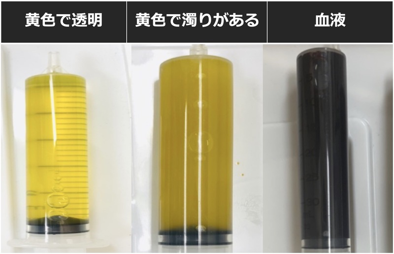 穿刺の比較
