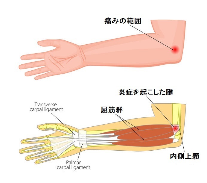 治りづらい肘の内側の痛み「上腕骨内側上顆炎（ゴルフ肘）」 | 長野整形外科クリニック
