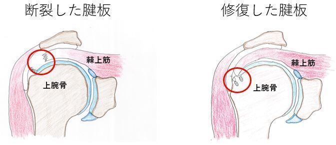 鏡視下腱板修復術（Debeyre-Patte変法）術後リハビリテーション | 上田 