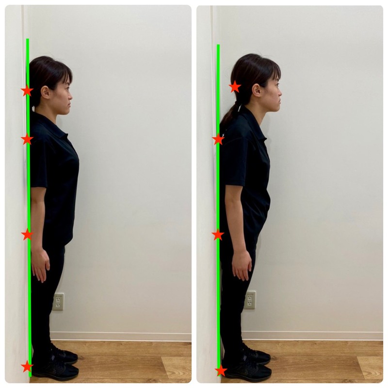 ストレートネックへの運動療法 アレックス脊椎クリニック