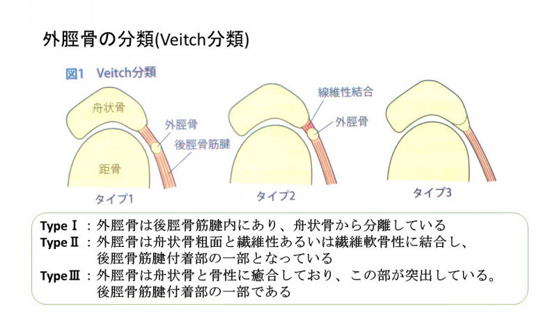 有痛性外脛骨障害 上田整形外科内科