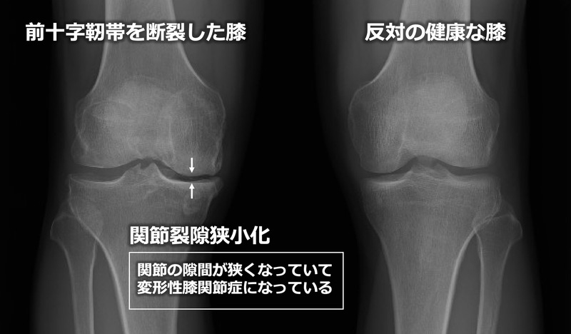 前十字靭帯とは | 都立大整形外科クリニック