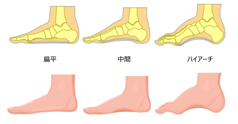 足底筋膜炎 靴のかたさ