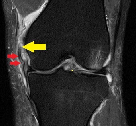 膝の内側靭帯損傷の原因と治療法 膝関節内側側副靭帯 Mcl 損傷 長野整形外科クリニック