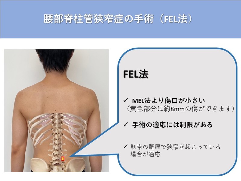脊柱管狭窄症、坐骨神経、腰椎椎間板ヘルニア - DVD/ブルーレイ