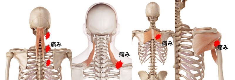 テレワークで起こりやすい腰痛 肩こり 首の痛み アレックス脊椎クリニック