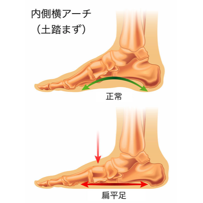 足底腱膜炎の症状や治療法 | 佐久平整形外科クリニック