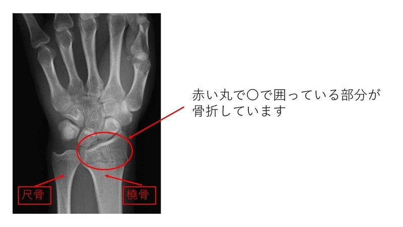 橈骨遠位端骨折 | 上田整形外科内科