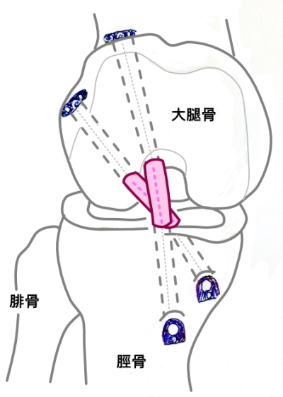 前十字靭帯の手術