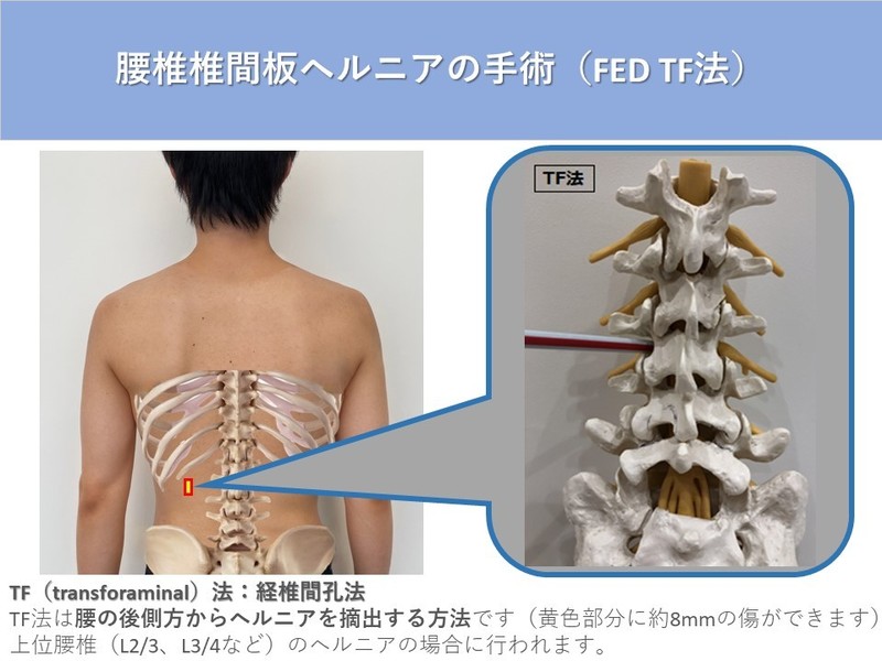 腰椎椎間板ヘルニアの手術 | アレックス脊椎クリニック