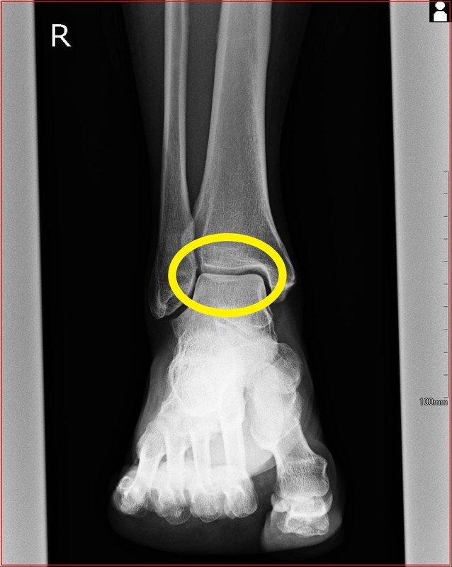 足関節の軟骨損傷の治療 都立大整形外科クリニック