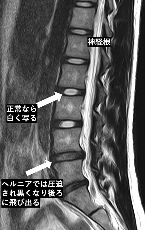 腰椎椎間板ヘルニア | 上田整形外科内科
