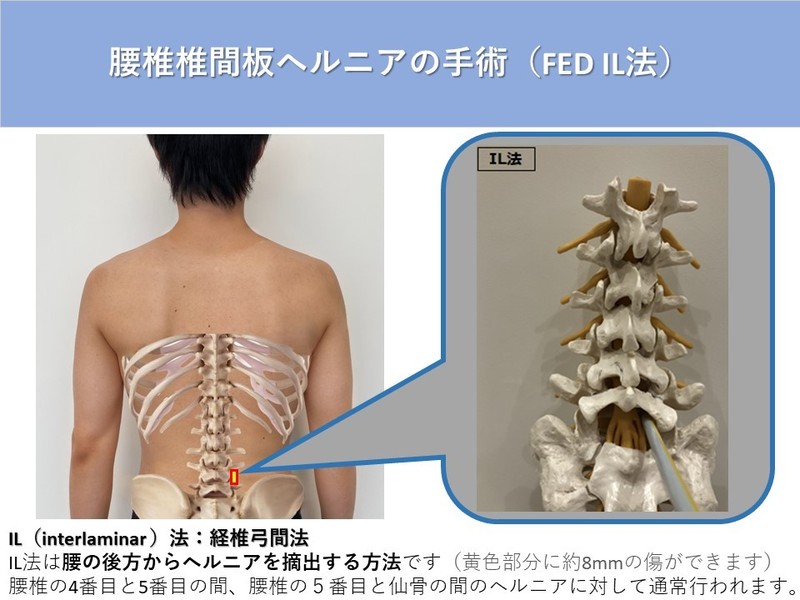 腰椎椎間板ヘルニアの手術 | アレックス脊椎クリニック