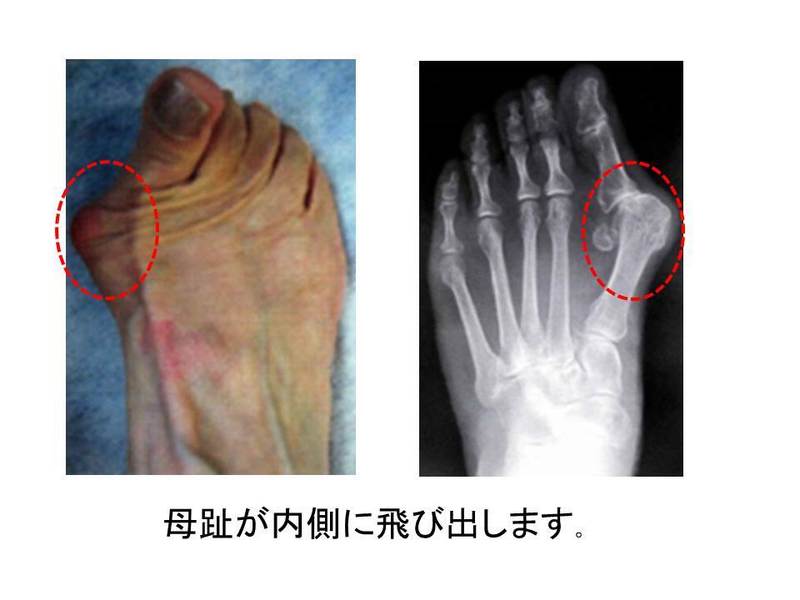 外反母趾 上田整形外科クリニック