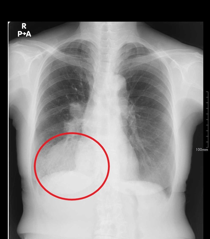 胸部レントゲン検査 | 上田整形外科内科