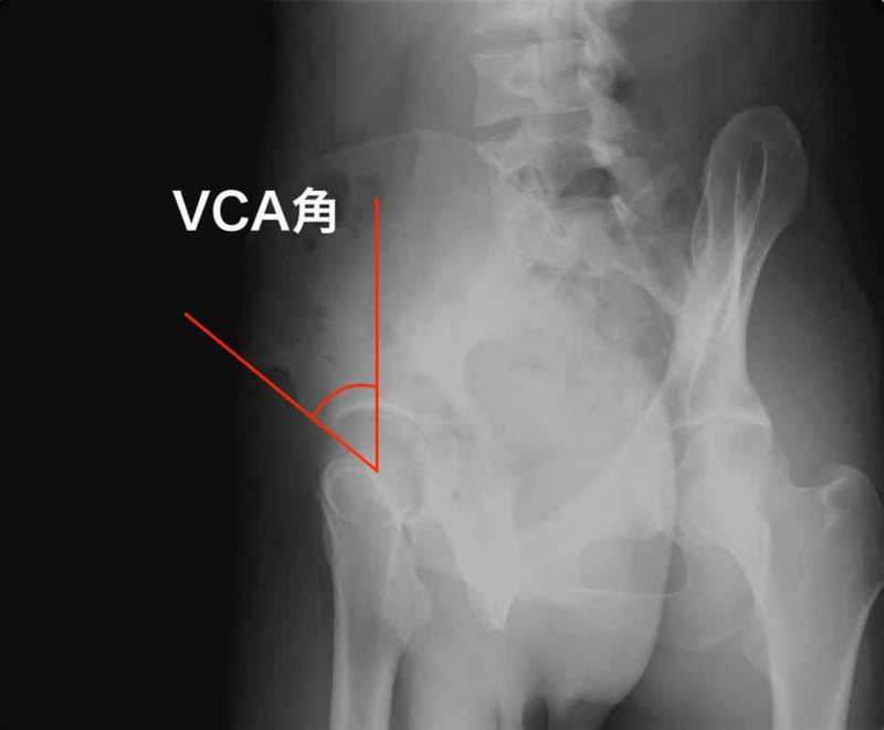 臼 不全 股関節 蓋 形成 股関節の痛みの原因となる寛骨臼形成不全（臼蓋形成不全）とは？ 症状や手術について