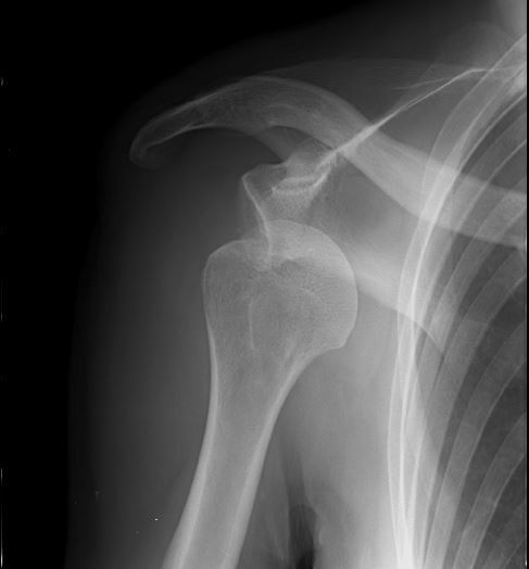肩の脱臼 肩が何度も抜ける 肩関節脱臼 反復性肩関節脱臼 長野整形外科クリニック
