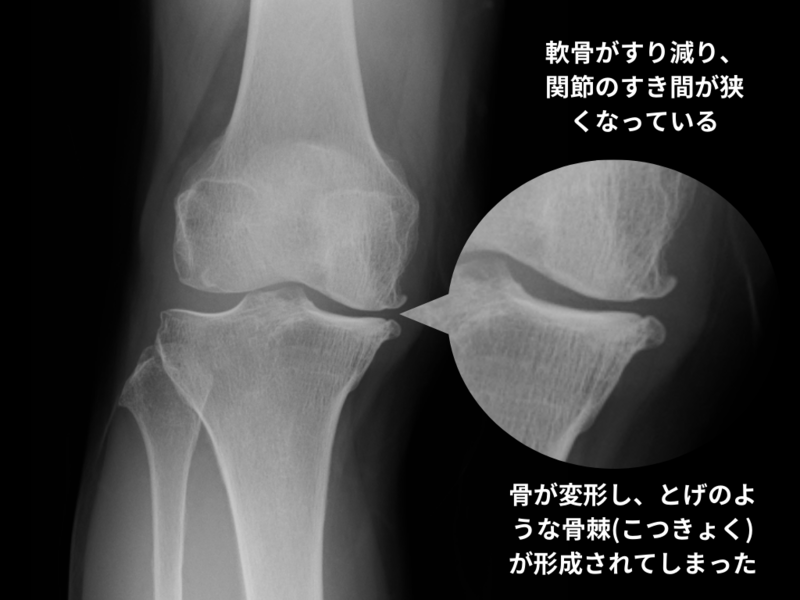 変形性膝関節症の治し方 | さいたま整形外科クリニック