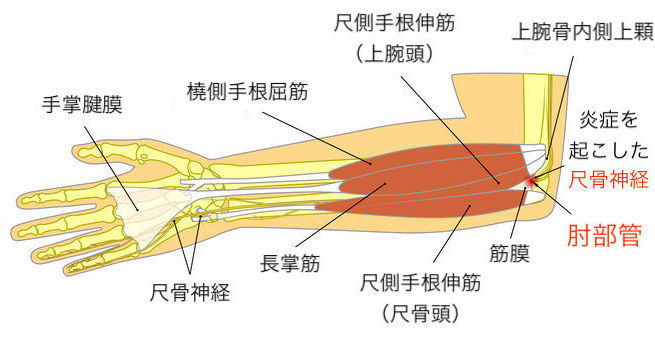 肘部管症候群の原因と治療法 | 佐久平整形外科クリニック