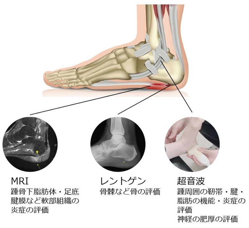 治りづらい足底腱膜炎の治療方法 Ar Ex スポーツ 難治性疼痛外来