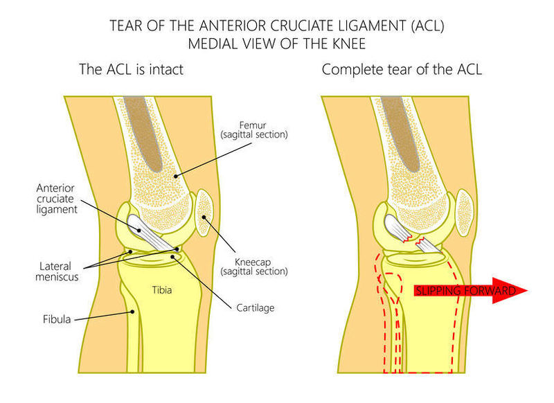 前十字靭帯損傷の治し方 | 都立大整形外科クリニック