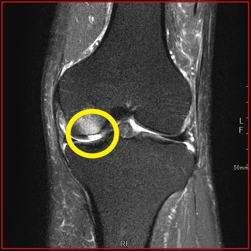 膝関節（軟骨と半月板）の痛みと治療 都立大整形外科クリニック