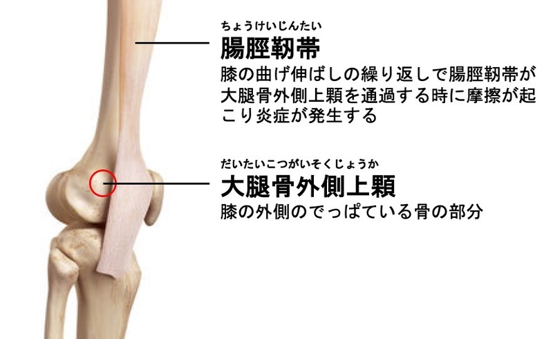 ランナー膝 腸脛靭帯炎 とは 膝の外側が痛くなるランニングフォームの改善方法 都立大整形外科クリニック