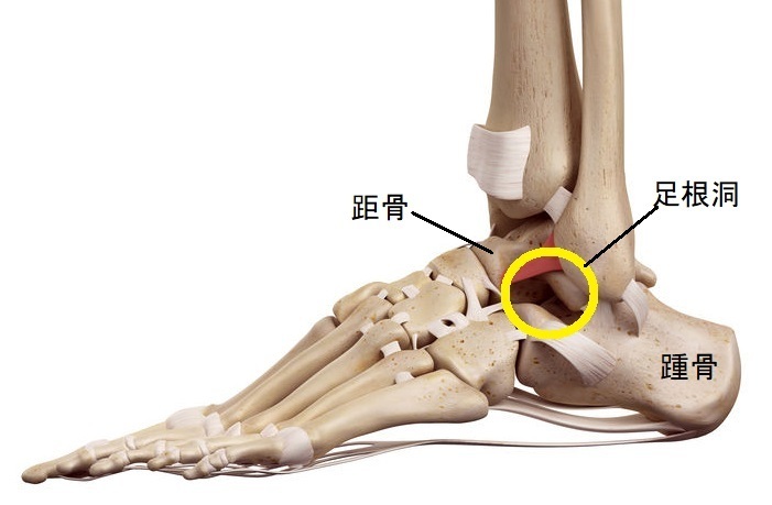 捻挫後の足の外側の痛み 歩行時痛と不安感 足根洞症候群 長野整形外科クリニック