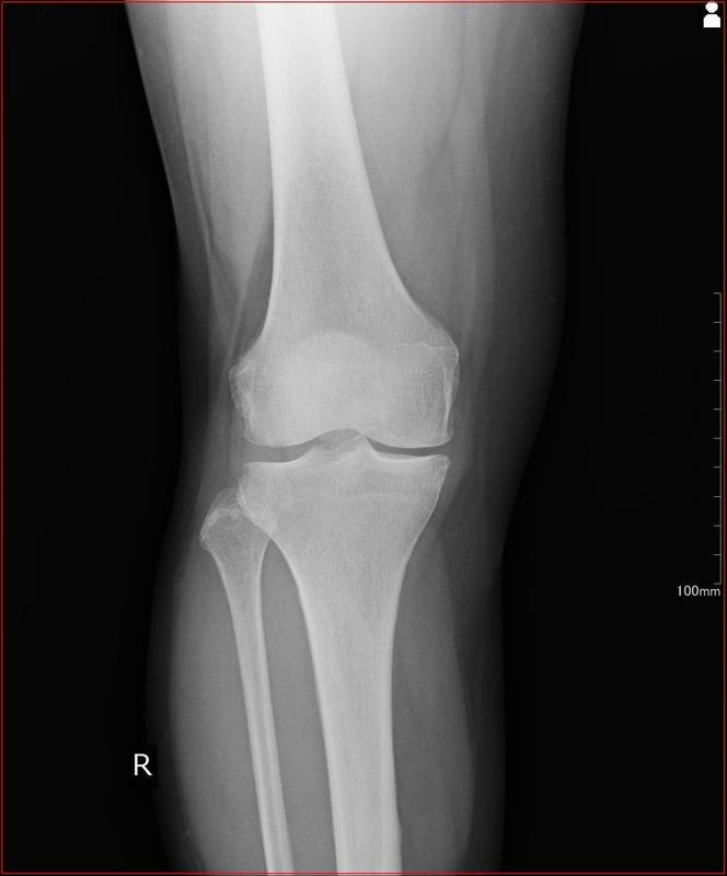 膝関節 軟骨と半月板 の痛みと治療 都立大整形外科クリニック