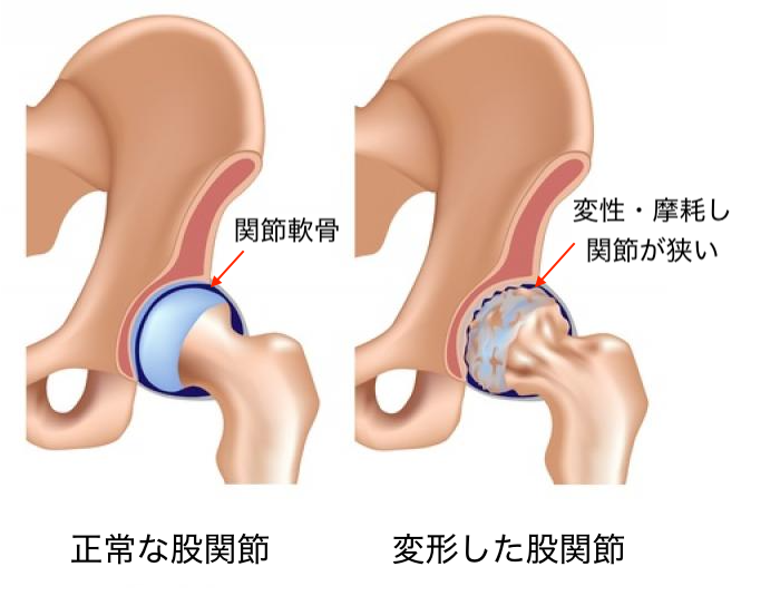 変形性股関節症の原因と治療法 | 佐久平整形外科クリニック