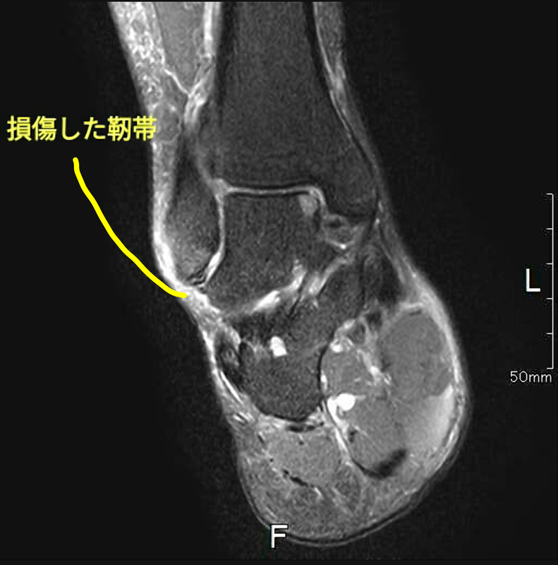 足関節外側靭帯損傷の手術 Ar Ex 尾山台整形外科