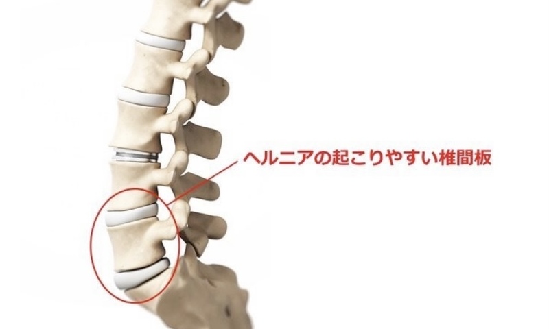 ヘルニアの外科 - その他