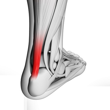 アキレス腱が断裂する原因と治療について アキレス腱断裂 長野整形外科クリニック